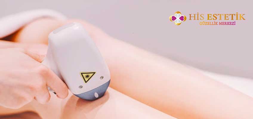 buz laser